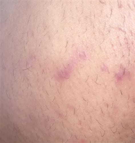 Itchy stretch marks… details in comments : r/Skincare_Addiction