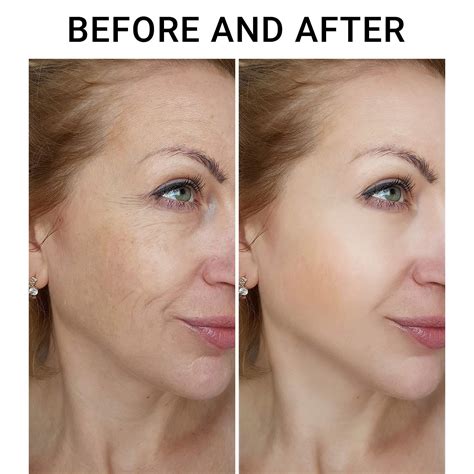 What is a face lifting procedure? – The Electric Kool