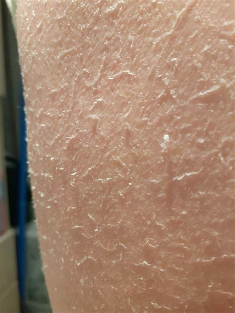 Extremely dry skin. Have you ever seen sth like that? What can be the cause? I provided more ...