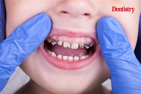 Almost 80% in healthcare report higher child tooth decay - Dentistry