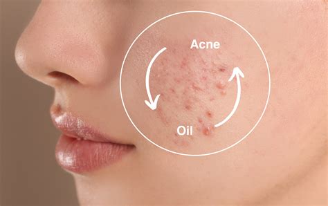 Is oily skin and acne-prone skin the same? - Cureskin