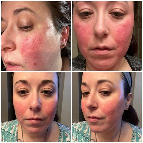 My Three Month Rosacea Journey with prescription topicals and otc products. Metronidazole .75% ...
