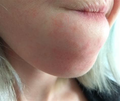 [Skin Concern] Hard Bumps on Chin | Beauty Skin Care