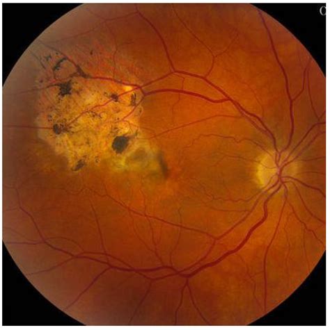 Tumor In Eye Treatment
