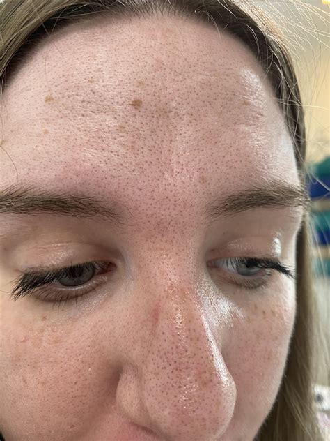 Why does my skin burn after applying Moisturizer but not after apply actives? : r/SkincareAddicts
