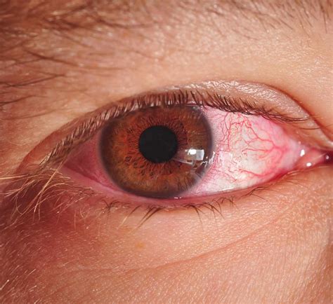 Allergic Conjunctivitis Discharge