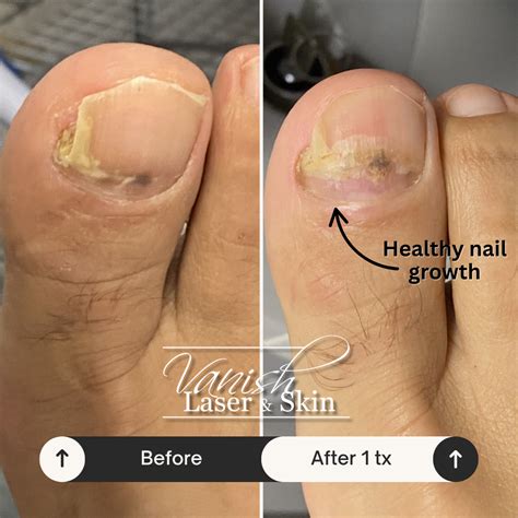 Nail Fungus Laser Treatments | Vanish Laser & Skin, Inc.