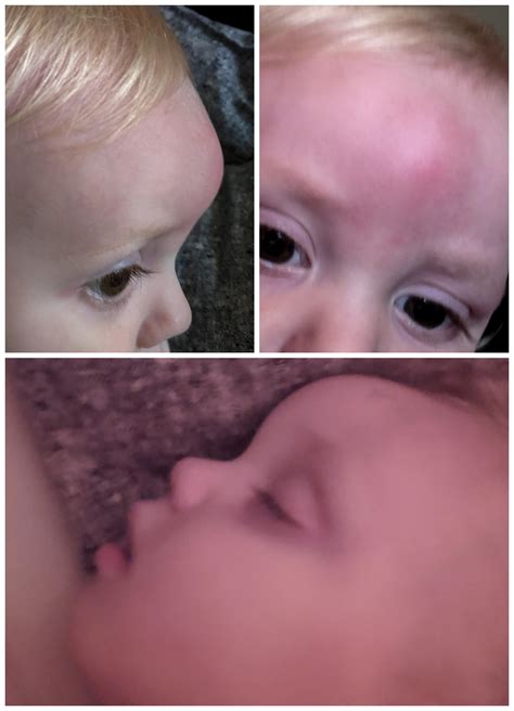 Very swollen forehead from bug bite on 17 month old. We noticed a mosquito bite(?) Two days ago ...