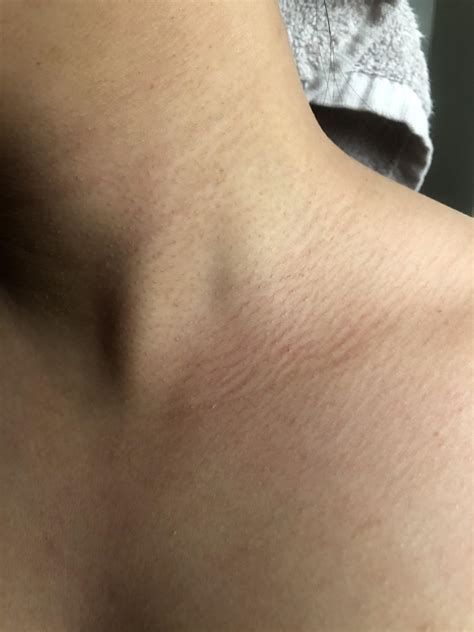 [Routine Help] I have these lines with small bumps on my neck to collarbone area. Any idea how ...