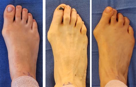 Bunion Surgery: reduced surgery time, more precise results and the best possible appearance of ...