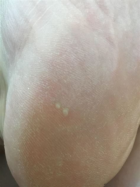 White Bumps On Baby Feet at Mike Lyles blog