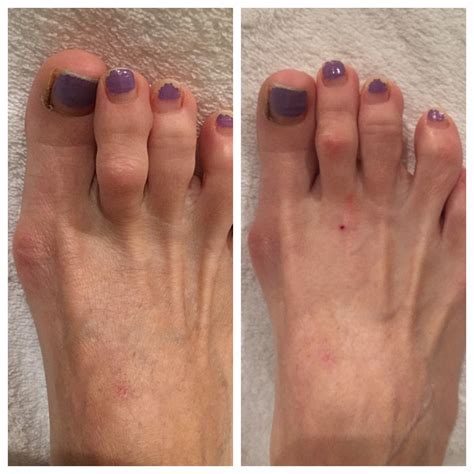 Hammertoes: Mild - 26 Foot & Ankle