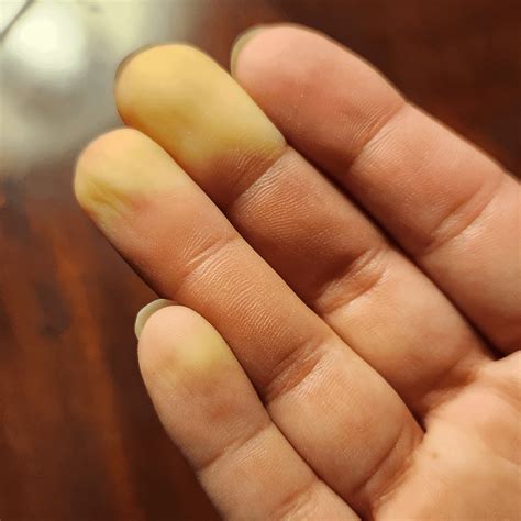 Constant runny nose? : r/Raynauds