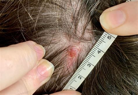What does melanoma look like on your scalp | Symptoms and pictures