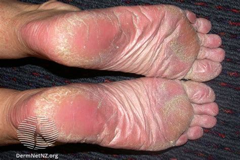 Foot Pain Due To Psoriatic Arthritis at Ron Edelstein blog