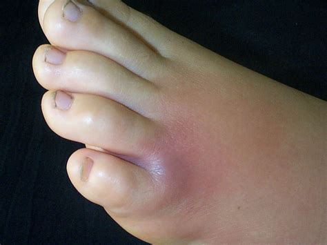 Bug Bite Swelling Foot