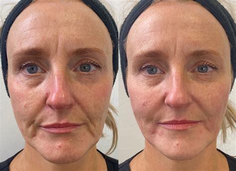 Fillers Before and After | Fillers for Face Before and After | Dermal Fillers Results | Dermal ...