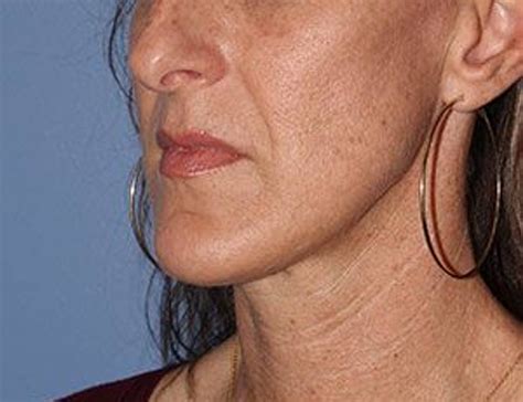 Chin Reduction Before & After Photos in Houston, TX | Face Forward
