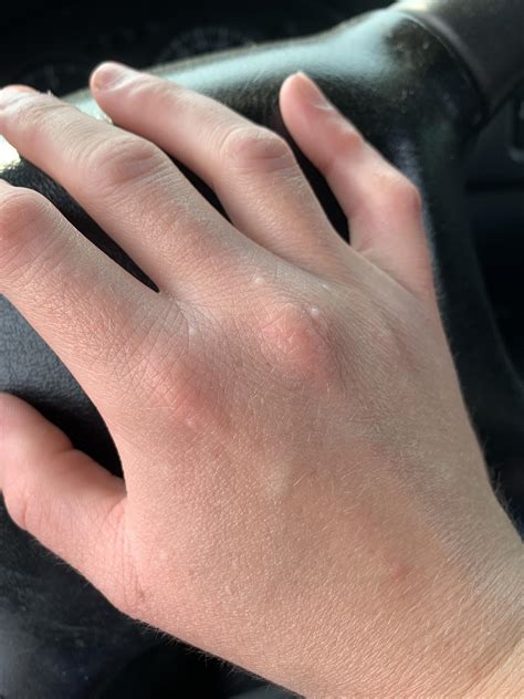 What are these white bumps on my hand? : r/DermatologyQuestions