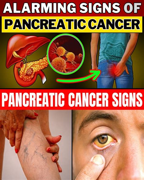 12 Subtle Signs of Pancreatic Cancer That Far Too Many People Brush Off as “Normal Aging ...