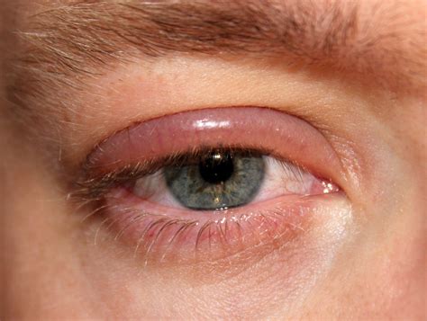 Blepharitis Treatment