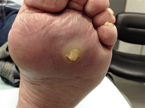 Corns and Calluses: Symptoms & Treatment in Singapore