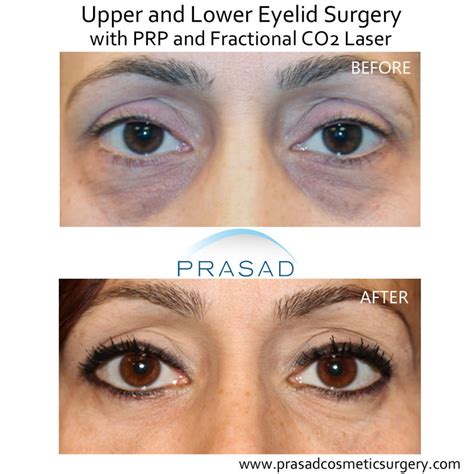 Laser Treatment for Dark Circles Under Eyes | Dr. Prasad Blog