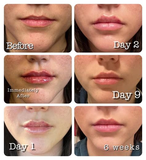 Lip Injections Before And After