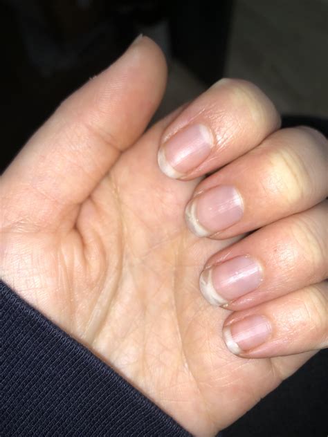 Does anyone know why the white parts of my nails are transparent in ...