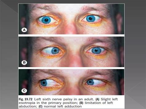 3rd, 4th, & 6th cranial nerve palsy | PPTX