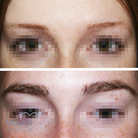 Eyebrow Hair Transplant | Medco Healthco | Stay Safe and Healthy