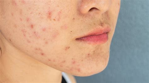 How To Deal With Period Acne | Reduces Acne Dark Spots | Serum For Acne – Suganda Skincare