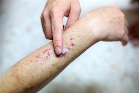 Purpuric Rash: Leg Symptoms, Images, Treatments