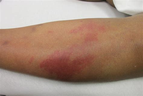 A 71y.o. woman with multiple sclerosis presents 3 wks after a feral cat ...