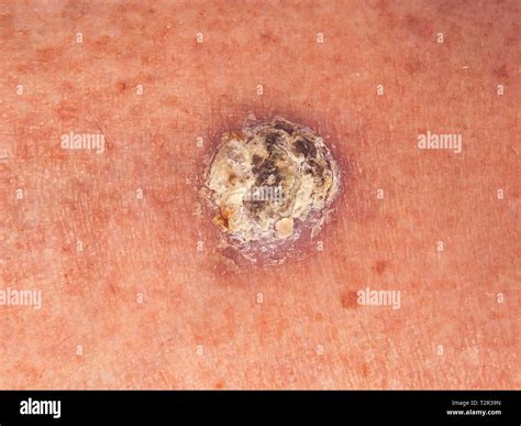 Basal Cell Carcinoma Nodular Type at Jeanette Upshaw blog