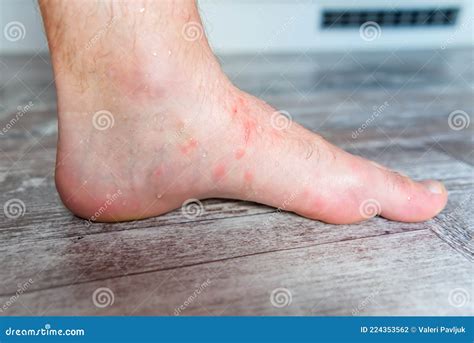 Mosquito Bites On Feet Won't Go Away at Maddison Pickworth blog