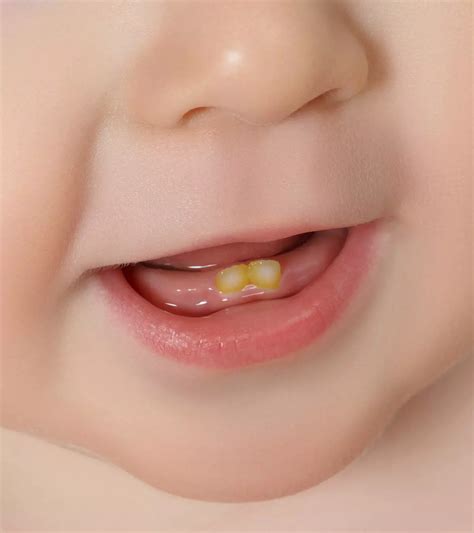 Is It Normal For A Baby To Be Born With Natal Teeth?