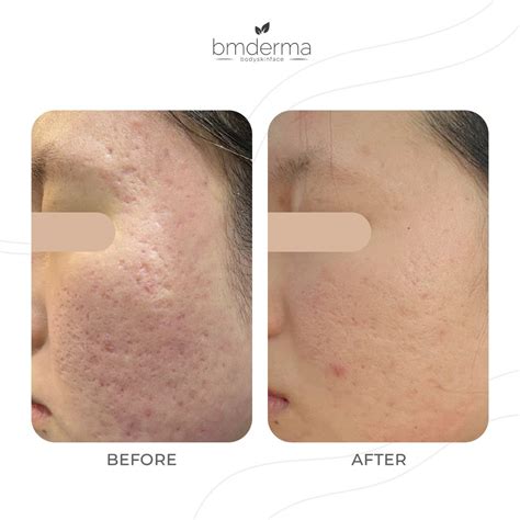 PORE SURGERY - BMDERMA