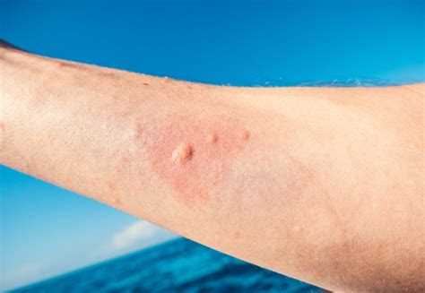 Jellyfish Sting: Treatment and Tips