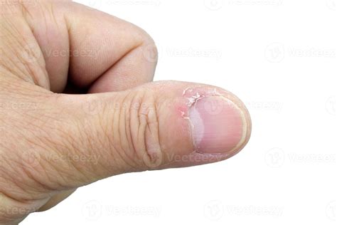 Fingernail Skin Peeling