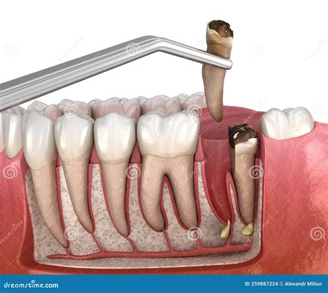Complex Tooth Extraction. Medically Accurate 3D Illustration of Dental Treatment Stock ...