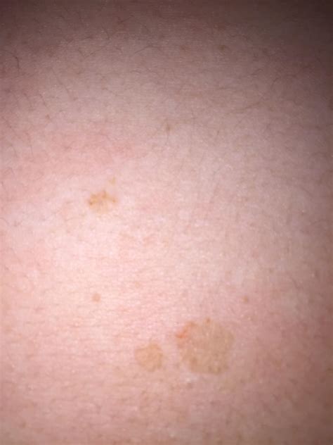 Red Spots On Chest Back And Shoulders at Robin Clark blog