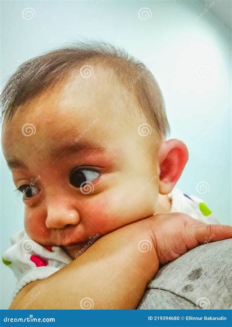 Adorable Baby with Skin Allergy on the Face. Reactions To the Dusts, Foods and Environment Stock ...