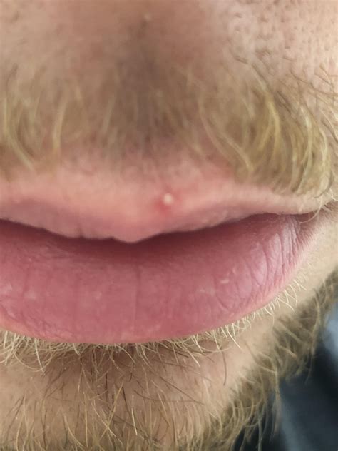 Whitehead On Lip