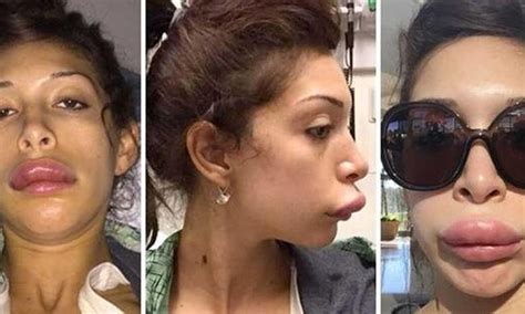 Botox Injections Gone Wrong