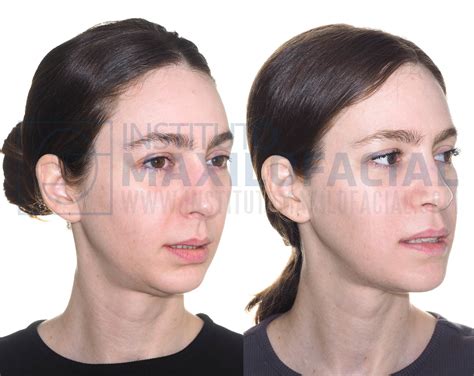 Leanne - Instituto Maxilofacial