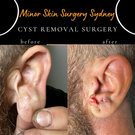 Cyst Surgery, Cyst Removal, Cyst Treatment Sydney