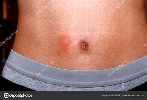 Itchy Rash On Stomach