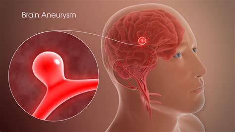 Brain Aneurysm Repair – Dr.Samir Parekh