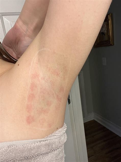 Is this burns? I’ve gotten laser hair removal for the last 2 years and ...